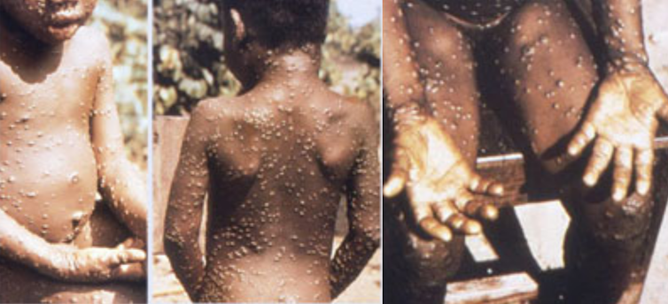 What is the monkeypox that has just appeared in the United Kingdom and what does it imply?