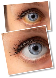 Difference between a normal eye and with the onset of jaundice
