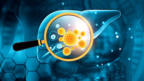 La nueva hepatitis infantil podría estar relacionada con la covid-19 La nueva hepatitis infantil podría estar relacionada con la covid-19