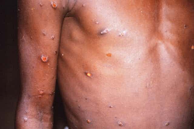 European outbreak of monkeypox: what you need to know