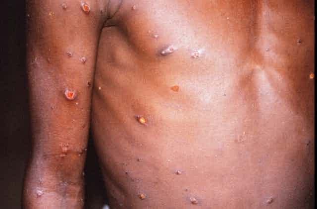 Épidémie de variole du singe : ce qu'on doit savoir
