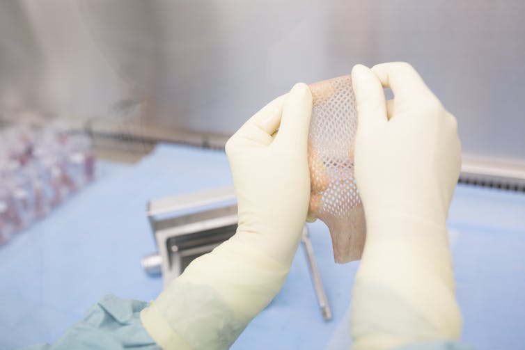 Gloved hands holding meshed skin graft