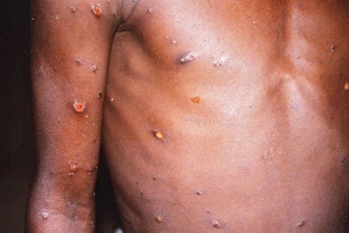 El virus de la viruela del simio es un viejo conocido El virus de la viruela del simio es un viejo conocido
