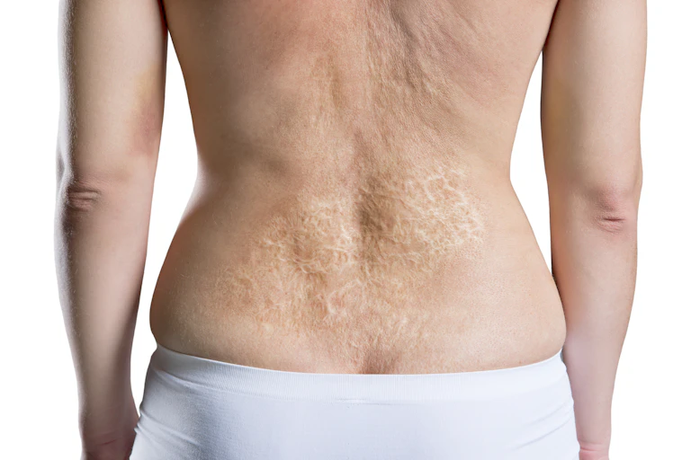 Burn scars on a person's back