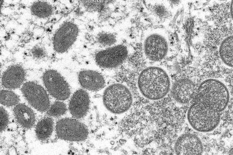 Electron microscope view of monkeypox, showing oval-shaped mature virus particles and immature spherical virions