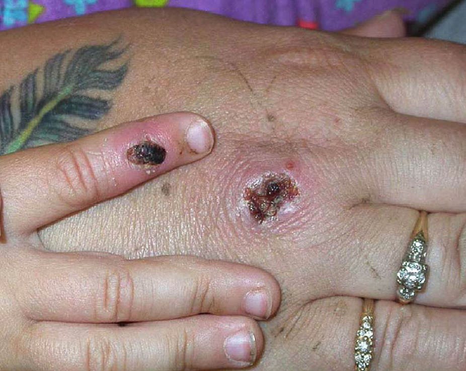 Hand with scabbed monkeypox lesions