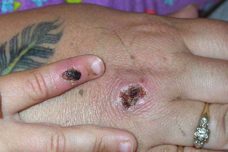 Hand with scabbed monkeypox lesions