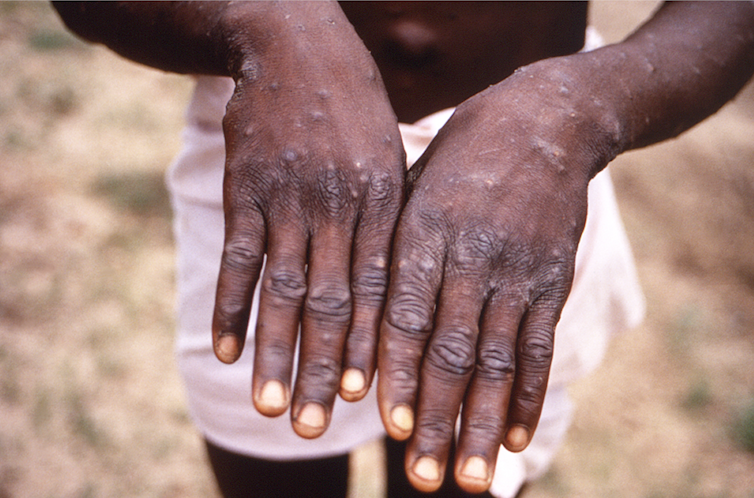 Man showing monkeypox rash on hands
