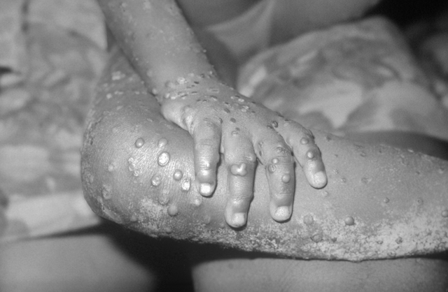 Monkeypox lesions on hand and leg