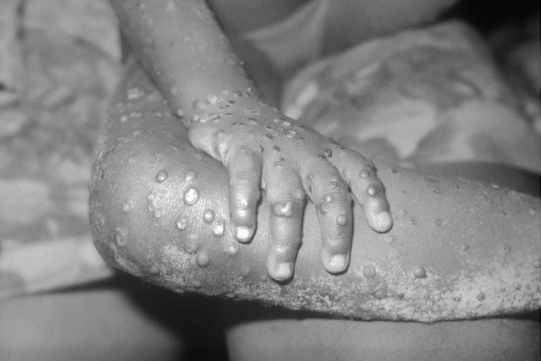 Monkeypox lesions on hand and leg