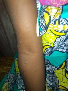 Photo of monkeypox virus lesions.