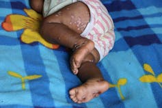Photo of an infant covered in monkeypox virus lesions.