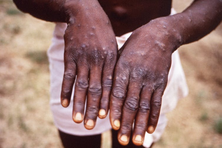 A person with monkeypox lesions on their hands.