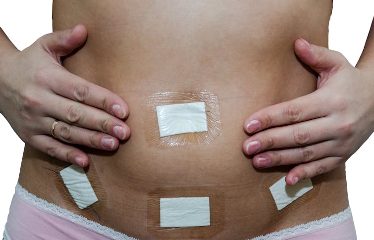A woman with dressings from a laparoscopy holds her tummy.