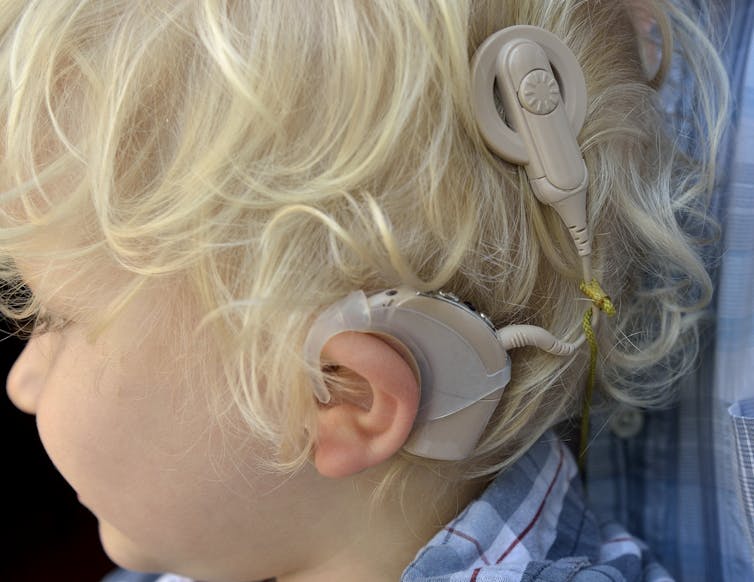 A side view of a child's head, showing cochlear implant equipment.