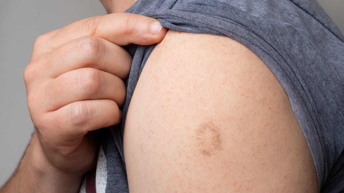 Monkeypox: we have vaccines and drugs to treat it