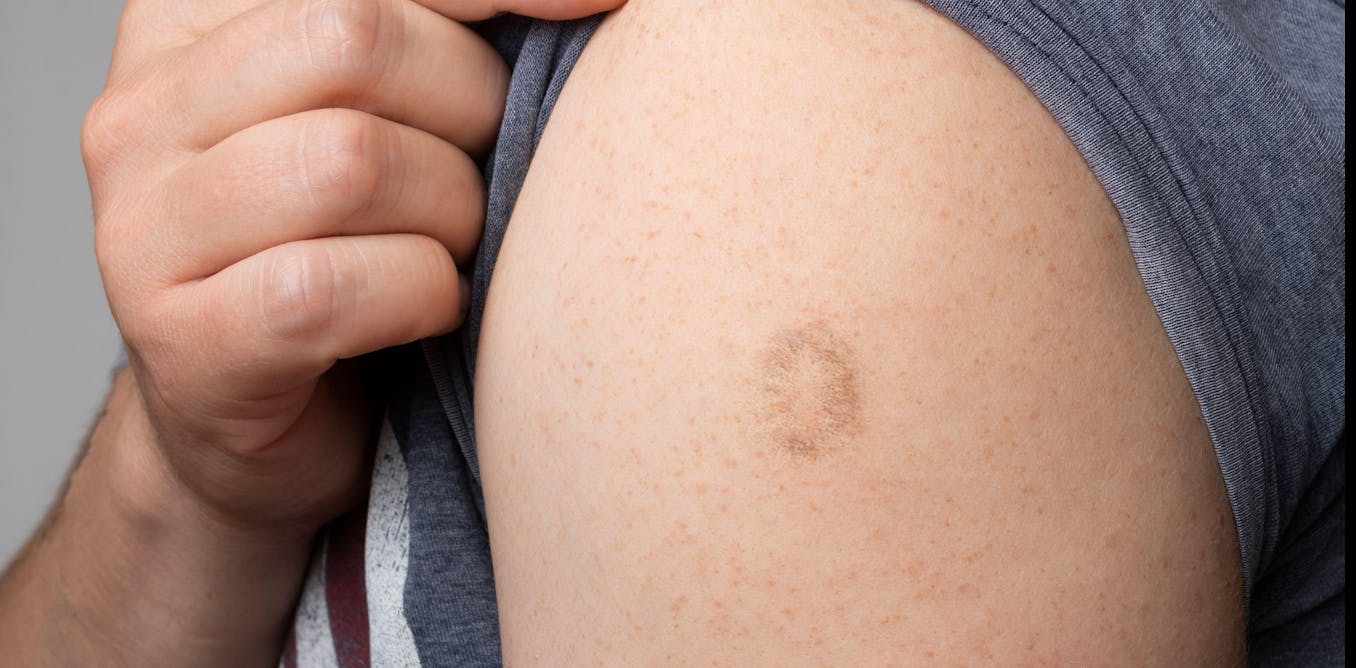 Monkeypox: We Have Vaccines And Drugs To Treat It