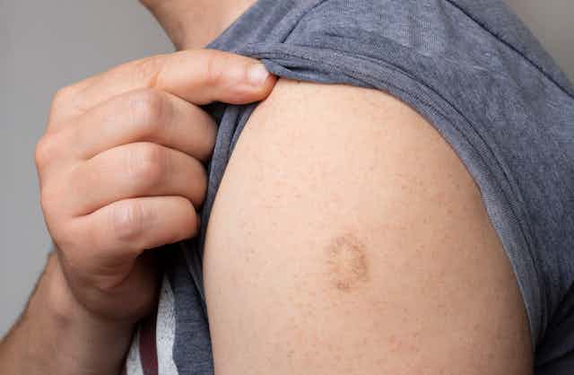 A man showing his smallpox vaccine scar.