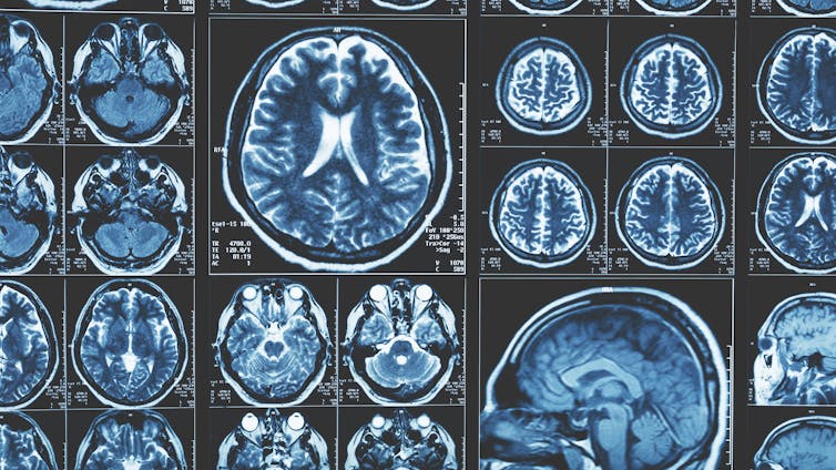 MRI images of the human brain.