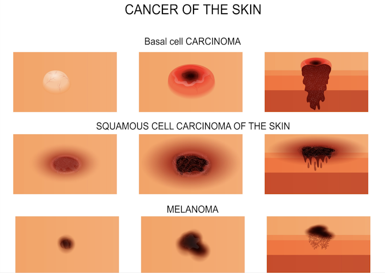 Vector showing different cancer examples