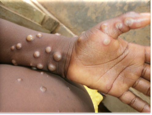 La dermatología de la viruela y cómo evitar sus cicatrices
