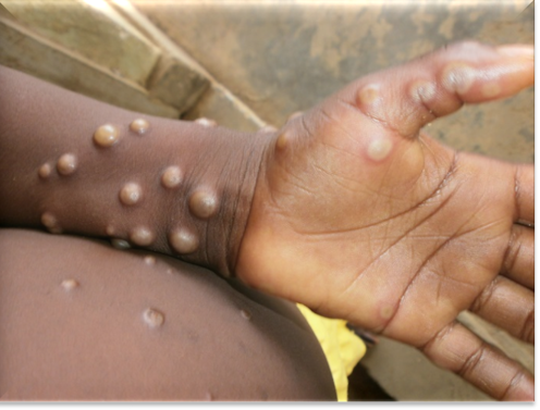 La dermatología de la viruela y cómo evitar sus cicatrices La dermatología de la viruela y cómo evitar sus cicatrices