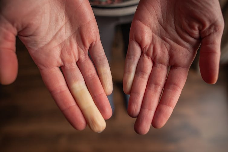 Une personne atteinte de la maladie de Raynaud montre ses mains où deux doigts sont blanchis