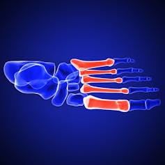 Bones of the feet, showing metatarsals
