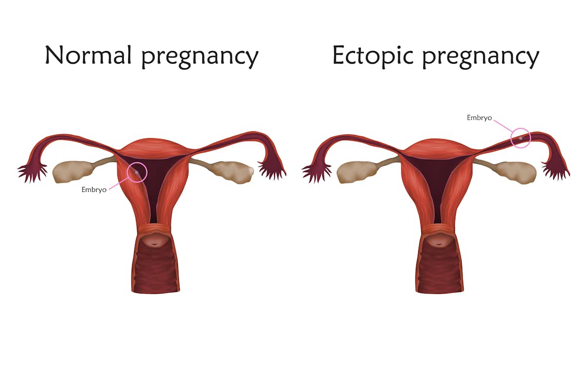 research articles on ectopic pregnancy