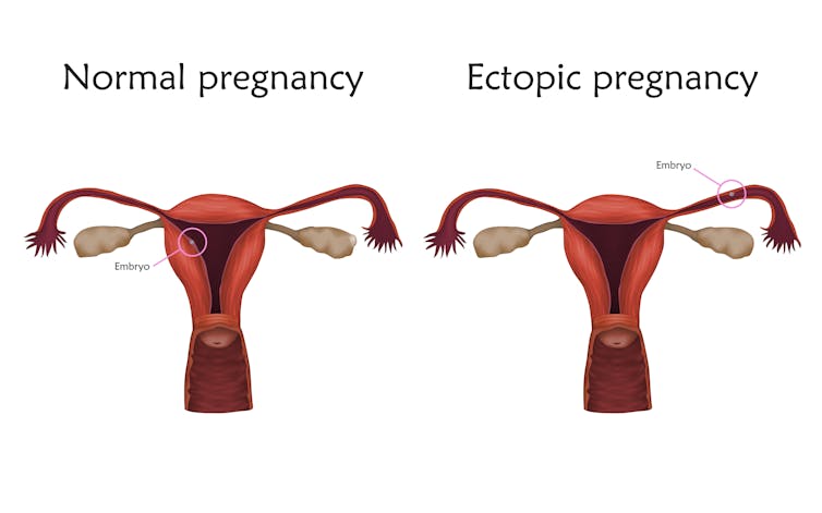 Side-by-side diagrams of the female reproductive system, one with an embryo in a uterine tube.