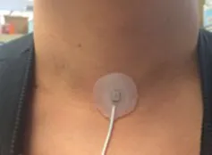 Closeup of a person's neck with a small round patch near the base of the neck with a white wire leading down from it