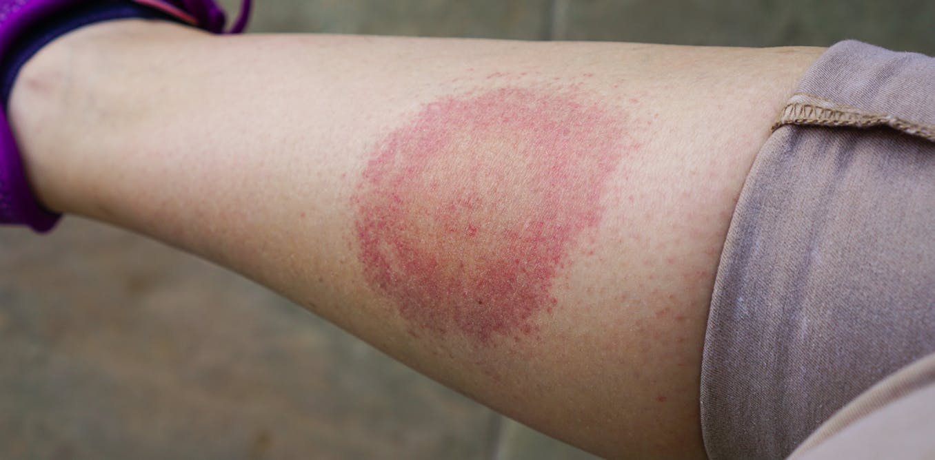 Por qué están aumentando los casos de la enfermedad de lyme en españa, europa y ee. Uu.