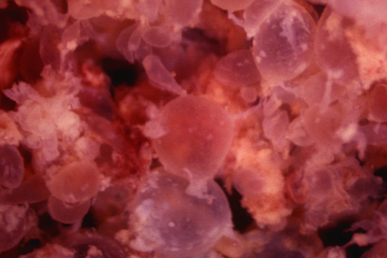 This ultra-magnified microscopic view of a ruptured ectopic pregnancy is an explosion of roundish blobs and indistinctly shaped bits in shades of pink, orange, red and purple.