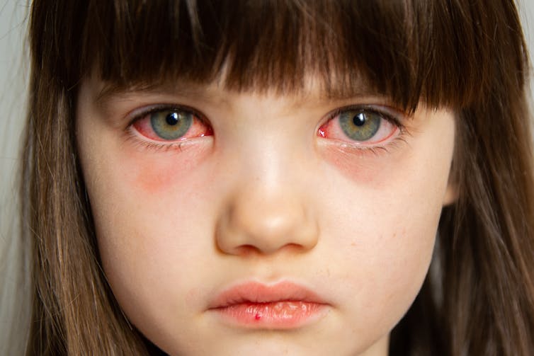 young girl with red sore eyes