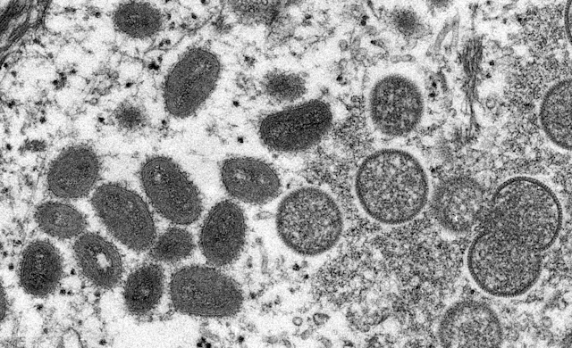 Electron micrograph of monkeypox virus particles