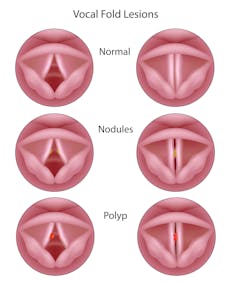 Illustrations of normal vocal cords, vocal cords with benign nodules and with benign polyps.