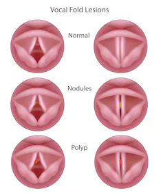 Illustrations of normal vocal cords, vocal cords with benign nodules and with benign polyps.