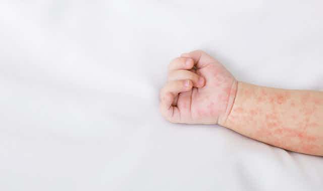Le bras d'un bébé couvert des boutons rouges de la rougeole