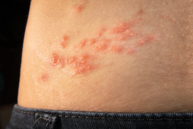 Shingles outbreak on the torso.