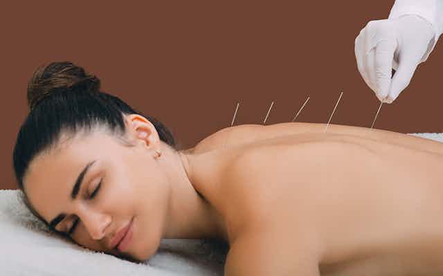 woman relaxes with acupuncture needles in back