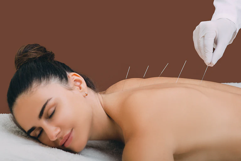 woman relaxes with acupuncture needles in back