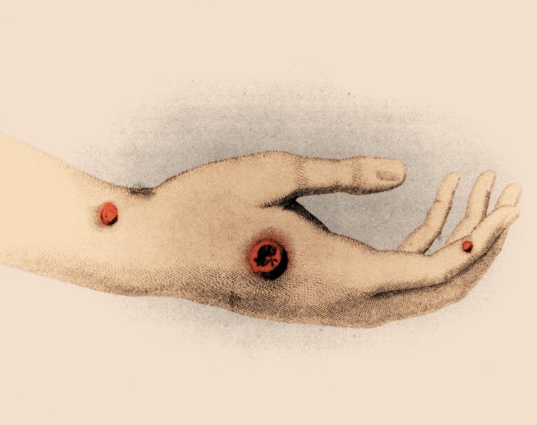 Drawing of a hand with smallpox pustules.
