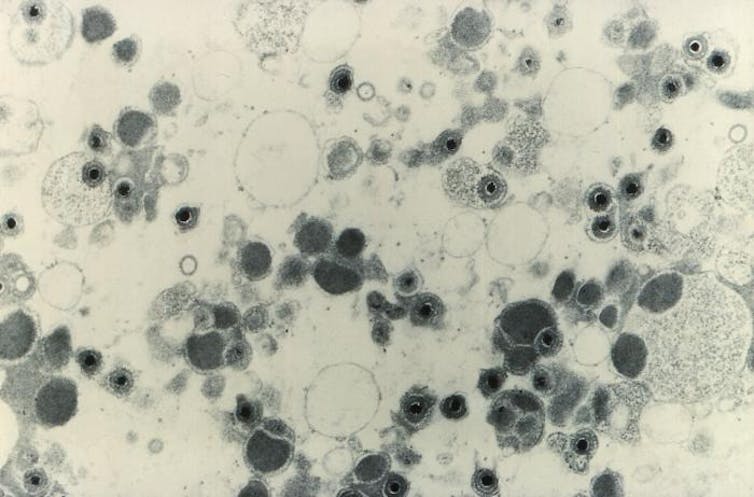 Electron microscope image of cytomegalovirus visions