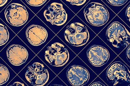 Las seis razones por las que cuesta tanto encontrar una cura para el alzhéimer