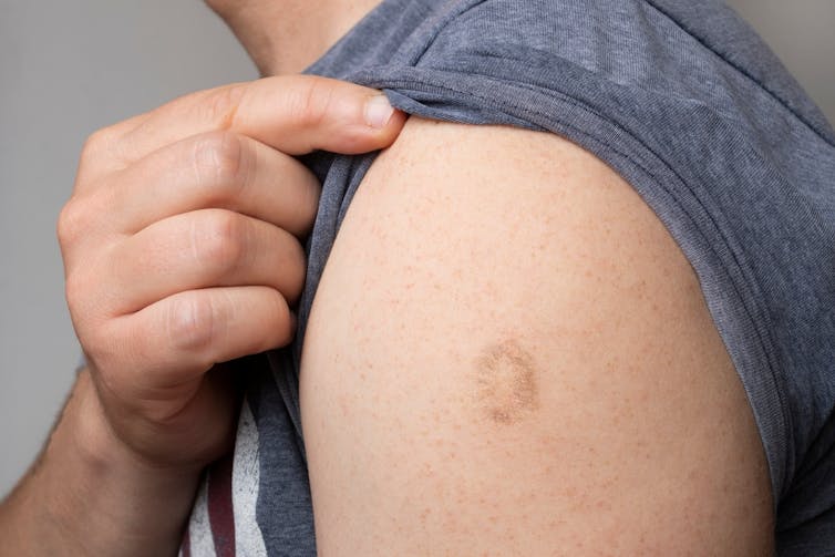 Man showing smallpox vaccine scar on upper arm