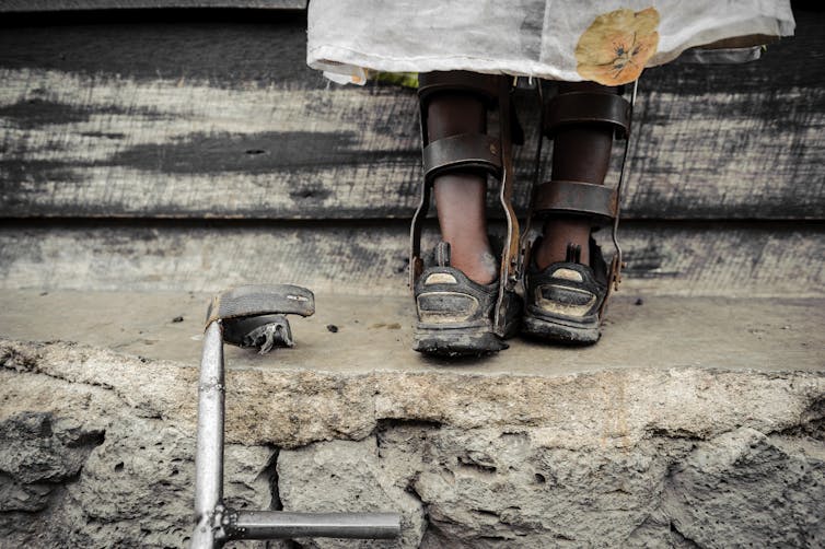 A child in calipers due to polio.