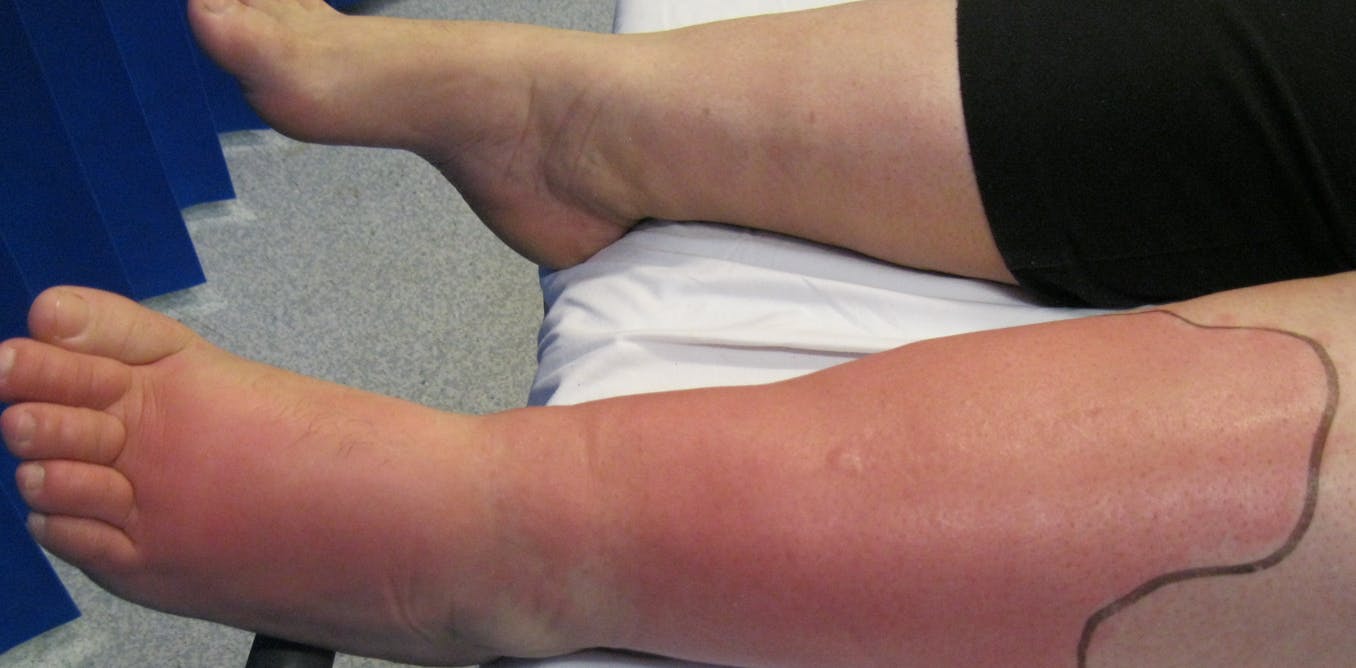 What's cellulitis? A dermatologist explains