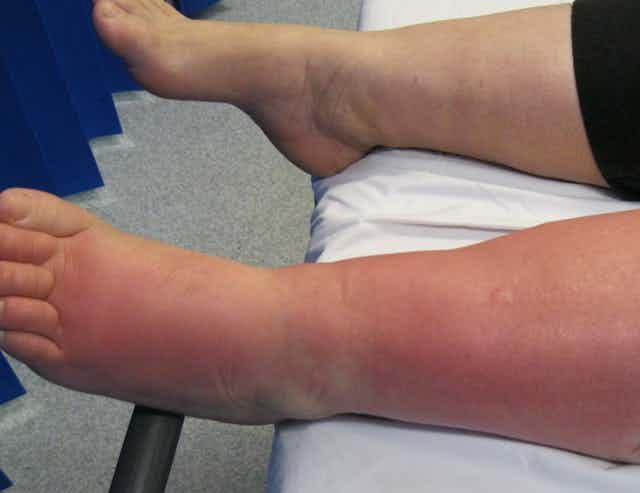 Two legs, one swollen and reddish pink