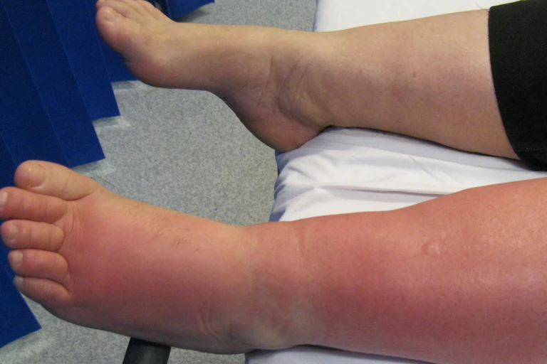 Two legs, one swollen and reddish pink
