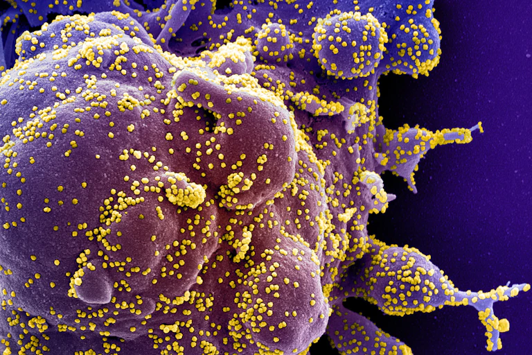 Micrographie électronique à balayage d'une cellule apoptotique infectée par le SARS-CoV-2, isolée à partir d'un échantillon provenant d’un patient.